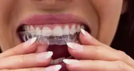 Guide to Nightguards from Nearby Dental Clinic AU, Ormeau