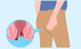 Expert Ano-Rectal Treatment in Noida for Piles & F, Noida