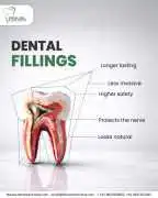 Best Dental Fillings in Noida for Cavities & Tooth, Noida