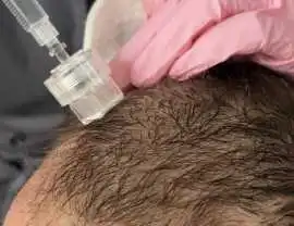 Top Benefits of Exosomes Hair Treatment in Perth, Subiaco