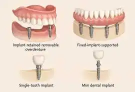 How Painful Is a Denture Implant Procedure?, Portland