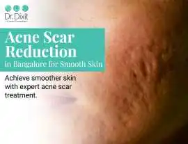 Get Smooth Skin with Acne Scar Reduction in Bangal, Bengaluru
