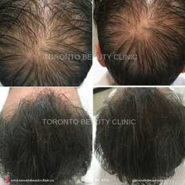 Looking For Best Post Menopause Hair Loss    , North York