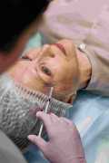 Botox Treatment in Warrenton at Lifestyle’s MedSpa, Warrenton