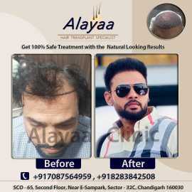 Get Natural and Permanent Hair Transplants Treatme, Chandigarh