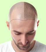 Discover the Best Hair Transplant Cost in Rajastha, Jaipur