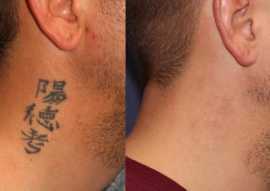 TATTOO REMOVAL CREAM +27799196969, NEW YORK, UK, Sandown