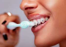 LIFE WITH BRACES: WHAT TO EXPECT IN THANE, Thane
