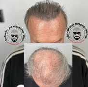 Scalp Micropigmentation Natural Hairline, Wilmington