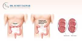 Advanced Colorectal Treatments by DrSumitObesityCa, Bengaluru