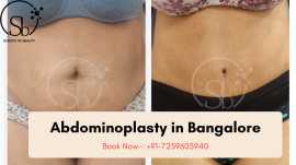 Abdominoplasty in Bangalore by Dr. Sandhya Bala, Bengaluru