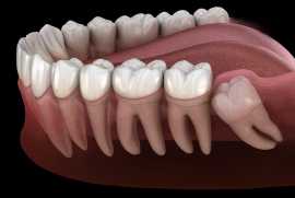 Wisdom Tooth Extraction Made Easy – Expert Care at, Euless