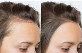 Scalp Micropigmentation: Thinning Hair Solution, Vancouver