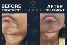  Best Homeopathic Vitiligo Treatment and Packs, Madurai