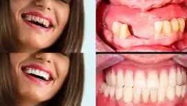 Restore Confidence with Full Mouth Rehabilitation, Delhi