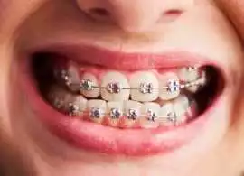 Affordable Braces in Gaithersburg, Gaithersburg