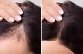 Scalp Tattoo Near Vancouver: Affordable Solution, Vancouver