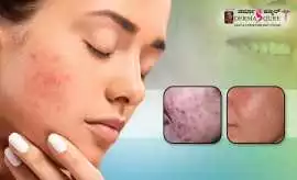 Best Deep Acne Scars Treatment in Bangalore, Bengaluru