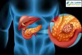 Best Pancreatic Surgeon in Sarjapur Road, Bengaluru