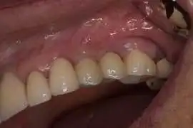 Dental crowns in Tijuana, Tijuana