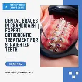 Dental Braces in Chandigarh  Expert Orthodontic , Chandigarh