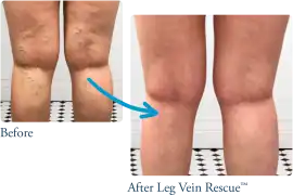 Venous Insufficiency Treatment & Care | Leg Vein R, Toronto