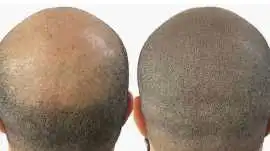 Professional hair pigmentation, Glasgow