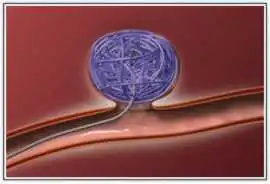Coil Embolization for Effective Aneurysm Care, Mohali