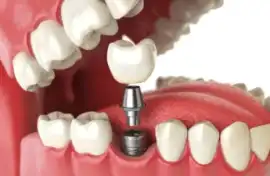 Best Dental Implant Clinic in Noida, Noida