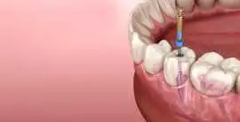 Advanced Root Canal Treatment in Thane, Thane