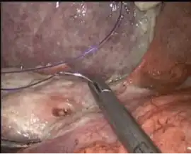Advanced Gastrointestinal Tumor Treatment by Exper, Ahmedabad