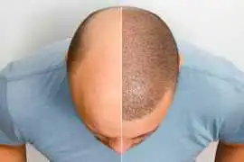 How to Choose the Best Hair Transplant in Varanasi, Allahabad