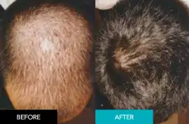 Seamless Integrated Hair System For Men, Subiaco