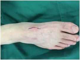 Ganglion Surgery Singapore: Advanced Techniques , Bukit Timah