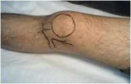 Knee Aspiration: Understanding the Procedure, Bukit Timah