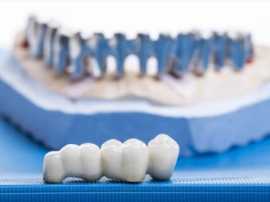 The Crown Jewel of Dentistry: Dental Crowning, Bukit Timah