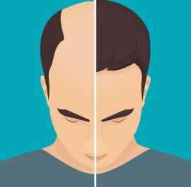 Hair Restoration from Hair Loss Perth Experts, Subiaco