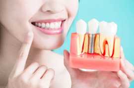 Affordable Dental Implants in Fort Worth, Fort Worth