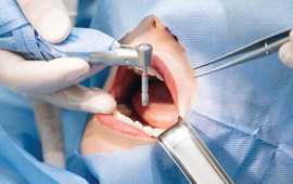 Top-Quality Root Canal Treatment in Ahmedabad, Ahmedabad