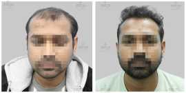Best Hair Restoration at Satya Hair Solutions in G, Delhi