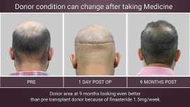  Achieve a Natural Look with FUE Hair Transplant i, Delhi