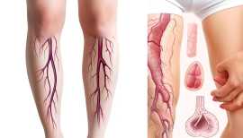 Leading Varicose Veins Treatment in Jaipur, Jaipur