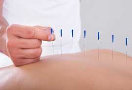 Acupuncture Therapy NYC, New York