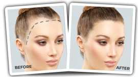 Reclaim Your Confidence  Female Hair Restoration, New Delhi