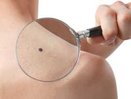 Safe Birthmark Removal Treatment in Rajasthan, Jaipur