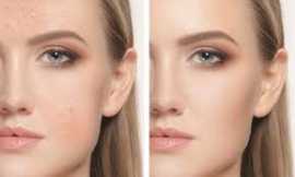 Discover the Best Wrinkle Reduction Treatment, Jacksonville