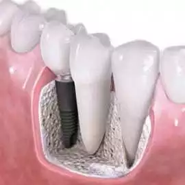 How Much Do Dental Implants Cost In Noida?, Noida