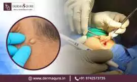 Affordable Sebaceous Cyst Removal Cost in Bangalor, Bengaluru