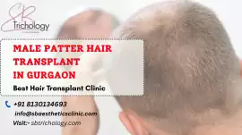 Male Pattern Hair Loss in Gurgaon | SB Trichology, Faridabad