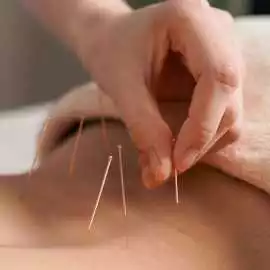 Acupuncture Trigger Point Therapy, South San Francisco